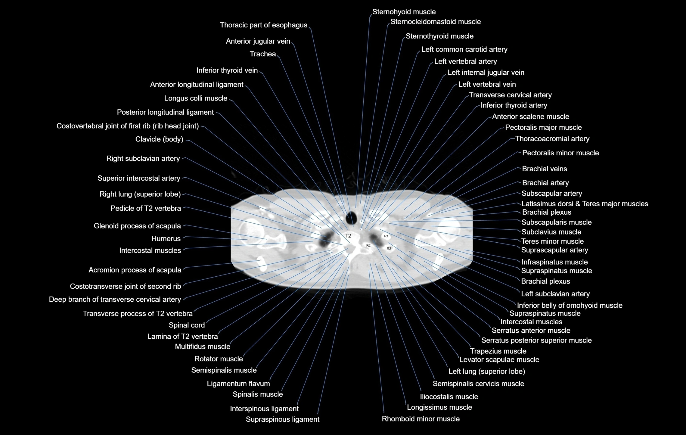 CT chest (thorax) labelled axial cross sectional anatomy radiology image-00007.webp